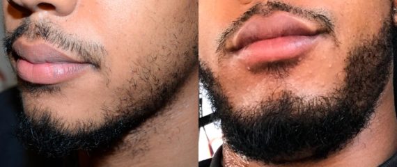 Facial Hair Transplant Before and after in Miami, FL, Paciente 58606
