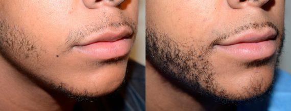 Facial Hair Transplant Before and after in Miami, FL, Paciente 58593