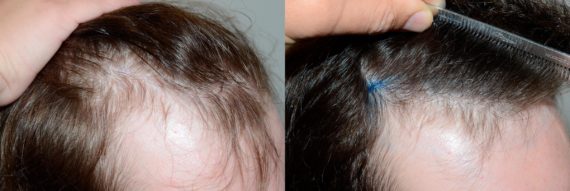 Hair Transplants for Men Before and after in Miami, FL, Paciente 58614