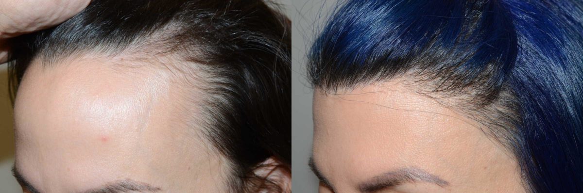 Hairline Advancement Before and after in Miami, FL, Paciente 58487