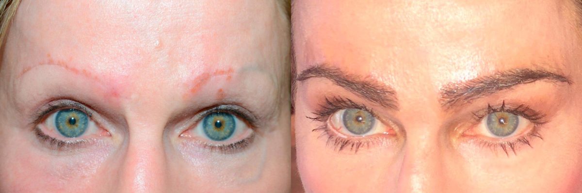 Eyebrow Hair Transplant Before and after in Miami, FL, Paciente 58513