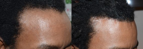 Hair Transplants for Men Before and after in Miami, FL, Paciente 58663