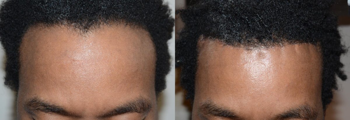 Hair Transplants for Men Before and after in Miami, FL, Paciente 58663