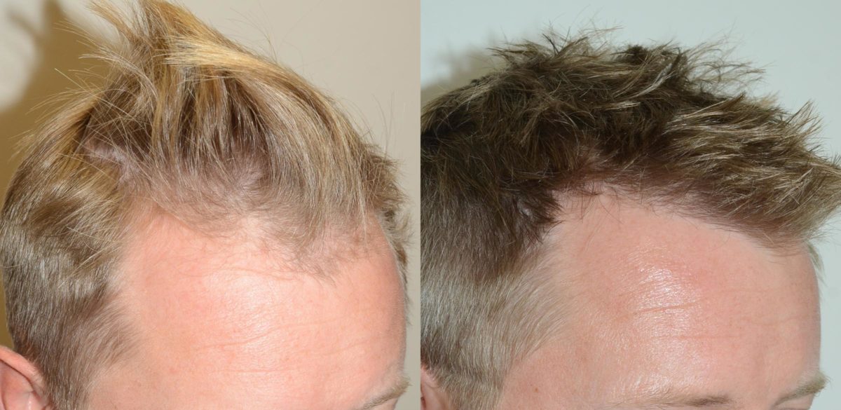 Hair Transplants for Men Before and after in Miami, FL, Paciente 58703