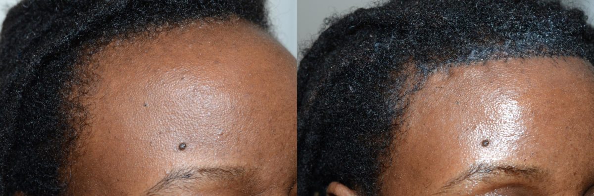 Hairline Advancement Before and after in Miami, FL, Paciente 58682