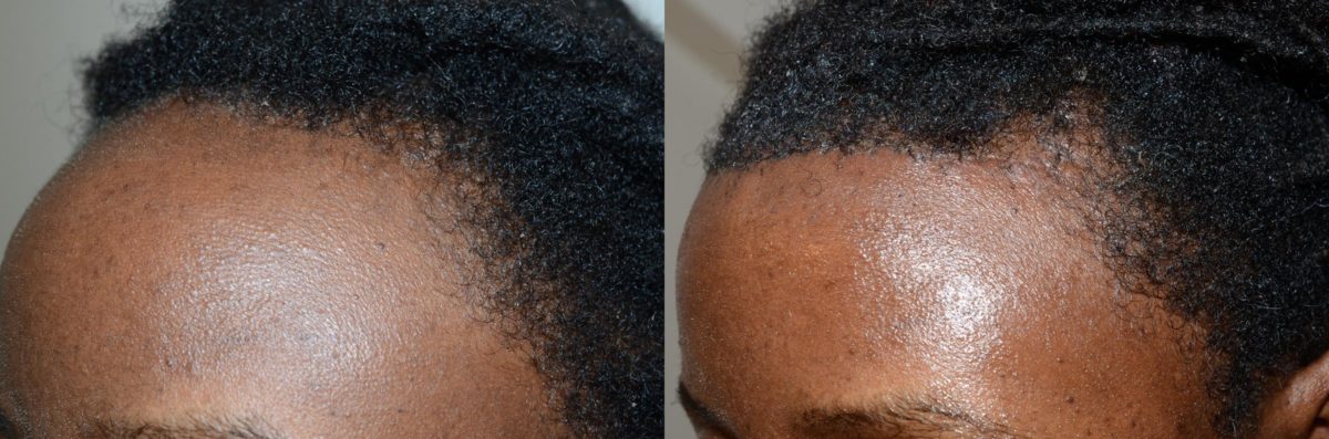 Hairline Advancement Before and after in Miami, FL, Paciente 58682