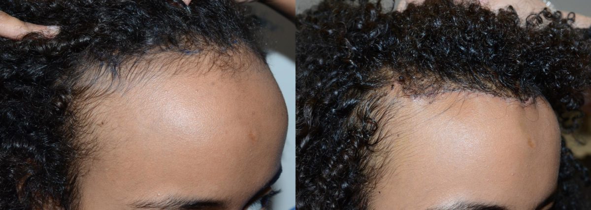 Hairline Advancement Before and after in Miami, FL, Paciente 58717