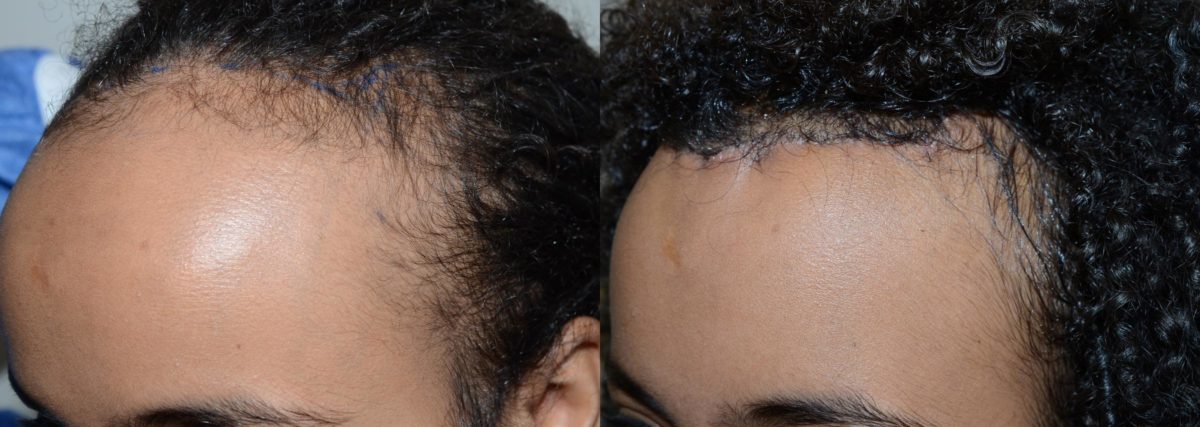 Forehead Reduction Surgery Before and after in Miami, FL, Paciente 58717