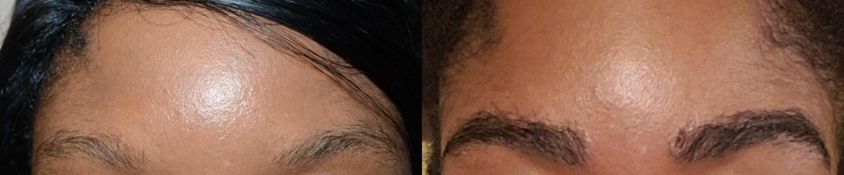 Eyebrow Hair Transplant Before and after in Miami, FL, Paciente 58778