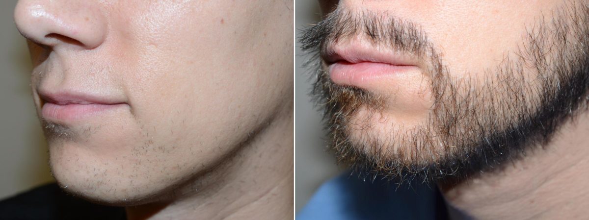 Trasplante de Pelo Facial Antes y después en Miami, FL, Paciente 71032
