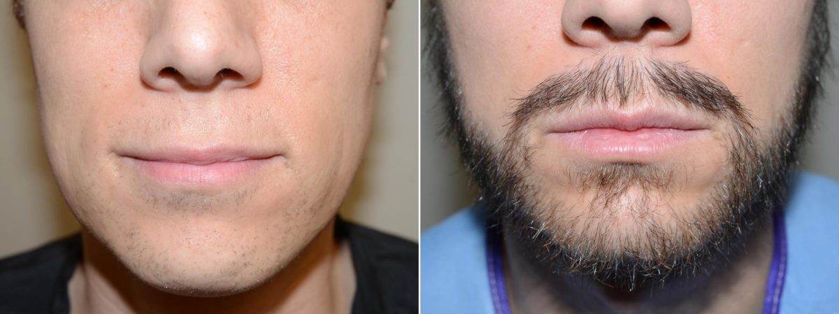 Facial Hair Before and after in Miami, FL, Paciente 58871