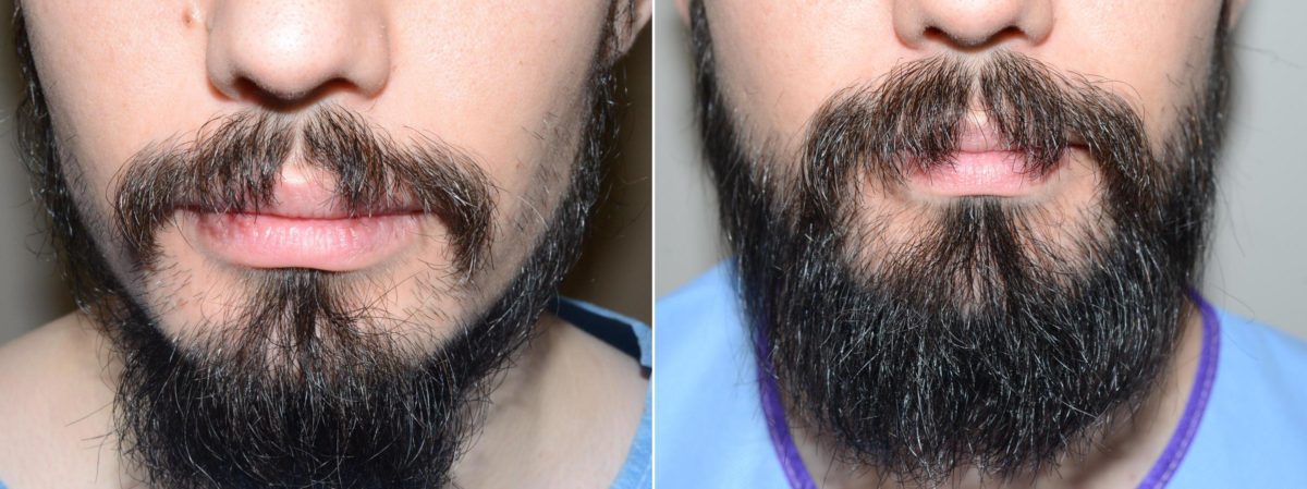 Trasplante de Pelo Facial Antes y después en Miami, FL, Paciente 71013