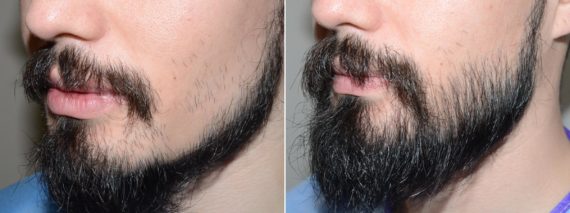 Facial Hair Before and after in Miami, FL, Paciente 58902