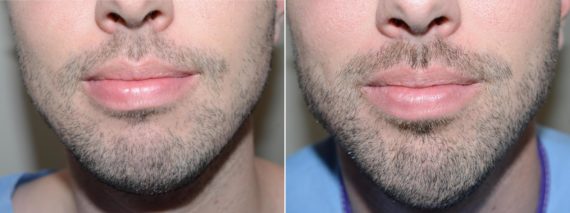 Facial Hair Before and after in Miami, FL, Paciente 58915