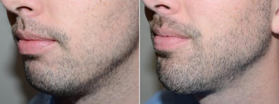 Facial Hair Transplant Before and after in Miami, FL, Paciente 58915