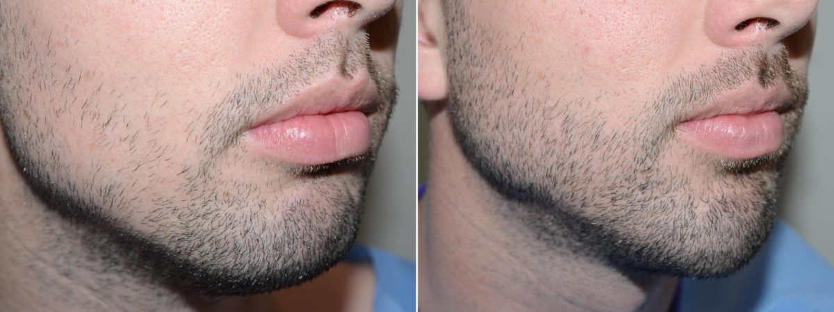 Facial Hair Transplant Before and after in Miami, FL, Paciente 58915