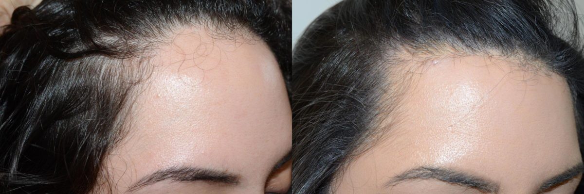 Hairline Advancement Before and after in Miami, FL, Paciente 58783