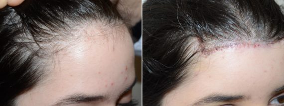 Forehead Reduction Surgery Before and after in Miami, FL, Paciente 58836