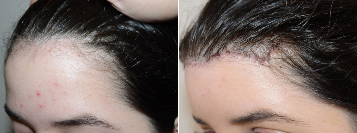 Forehead Reduction Surgery Before and after in Miami, FL, Paciente 58836
