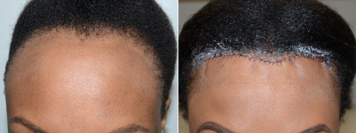 Forehead Reduction Surgery Before and after in Miami, FL, Paciente 58851