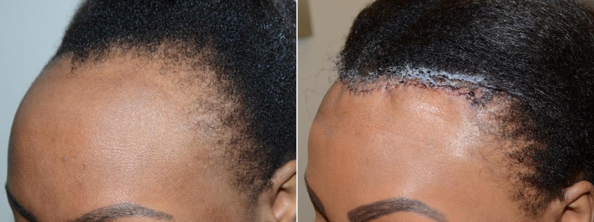 Hairline Advancement Before and after in Miami, FL, Paciente 58851