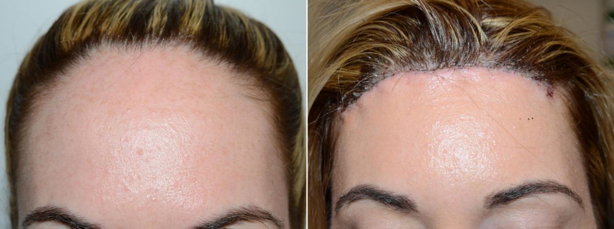 Forehead Reduction Surgery Before and after in Miami, FL, Paciente 58861