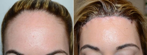 Hairline Advancement Before and after in Miami, FL, Paciente 58861