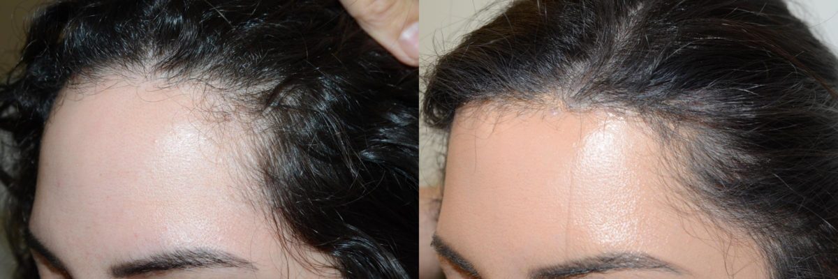 Hairline Advancement Before and after in Miami, FL, Paciente 58783