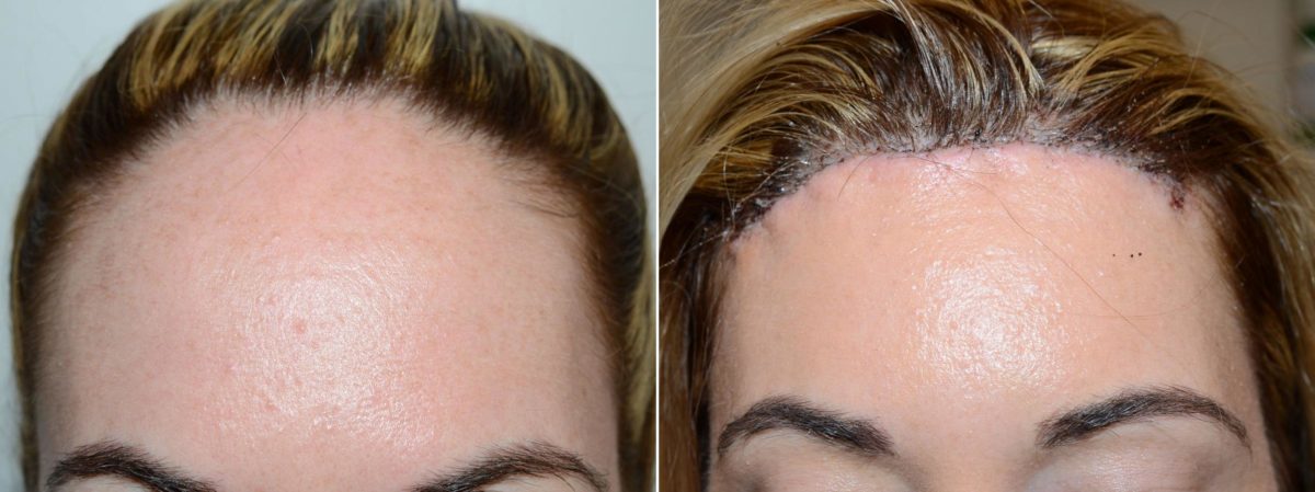 Hairline Advancement Before and after in Miami, FL, Paciente 58825