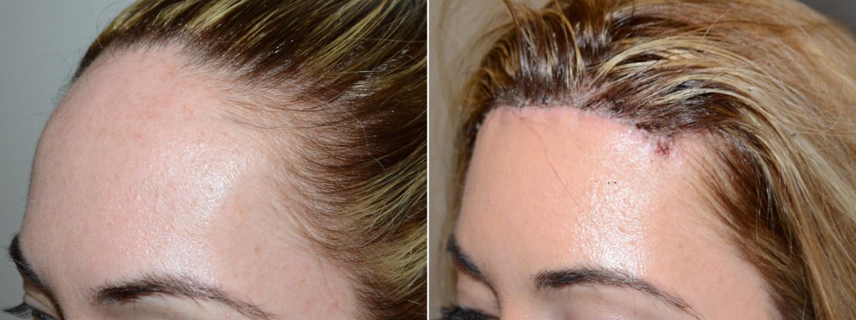 Hairline Advancement Before and after in Miami, FL, Paciente 58825