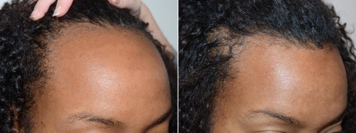 Hairline Advancement Before and after in Miami, FL, Paciente 58881