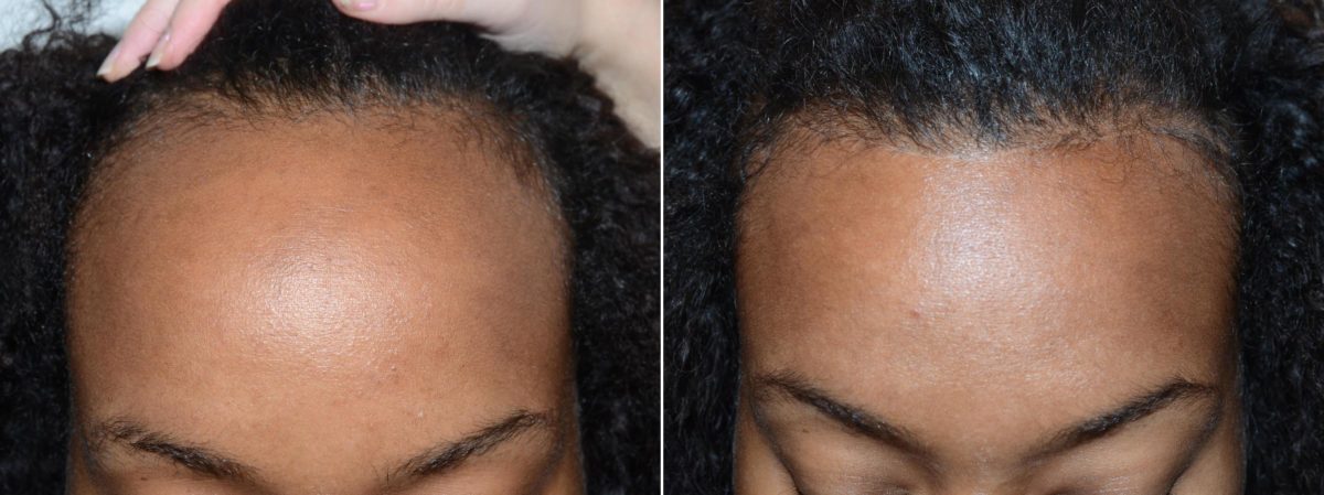 Hairline Advancement Before and after in Miami, FL, Paciente 58881