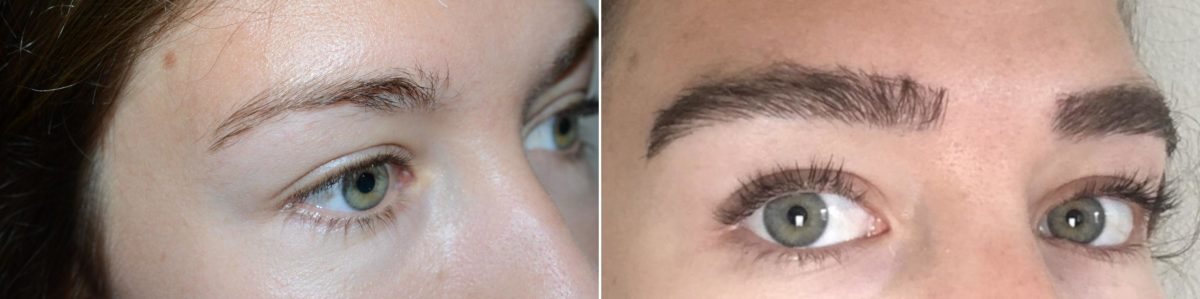Eyebrow Hair Transplant Before and after in Miami, FL, Paciente 58952