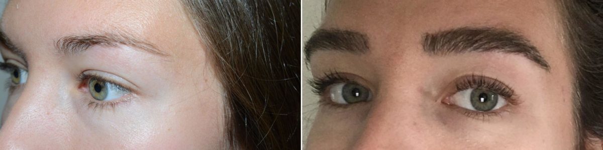 Eyebrow Hair Transplant Before and after in Miami, FL, Paciente 58952