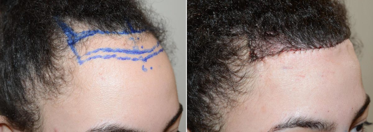 Forehead Reduction Surgery Before and after in Miami, FL, Paciente 58944