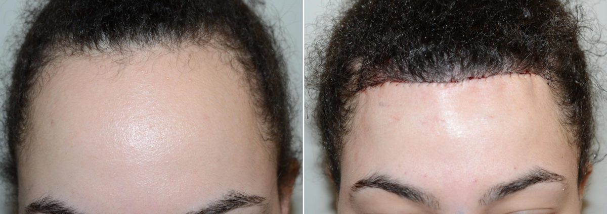 Hairline Advancement Before and after in Miami, FL, Paciente 58944
