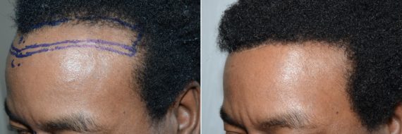 Hairline Advancement Before and after in Miami, FL, Paciente 58967