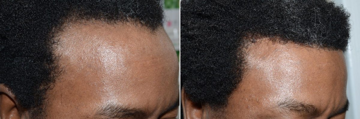 Hairline Advancement Before and after in Miami, FL, Paciente 58967