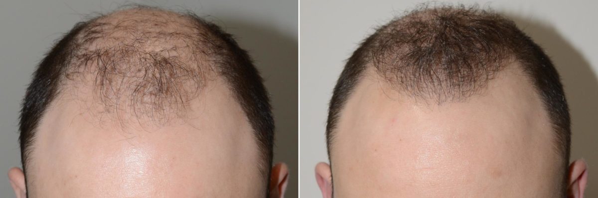 Body Hair Before and after in Miami, FL, Paciente 59126
