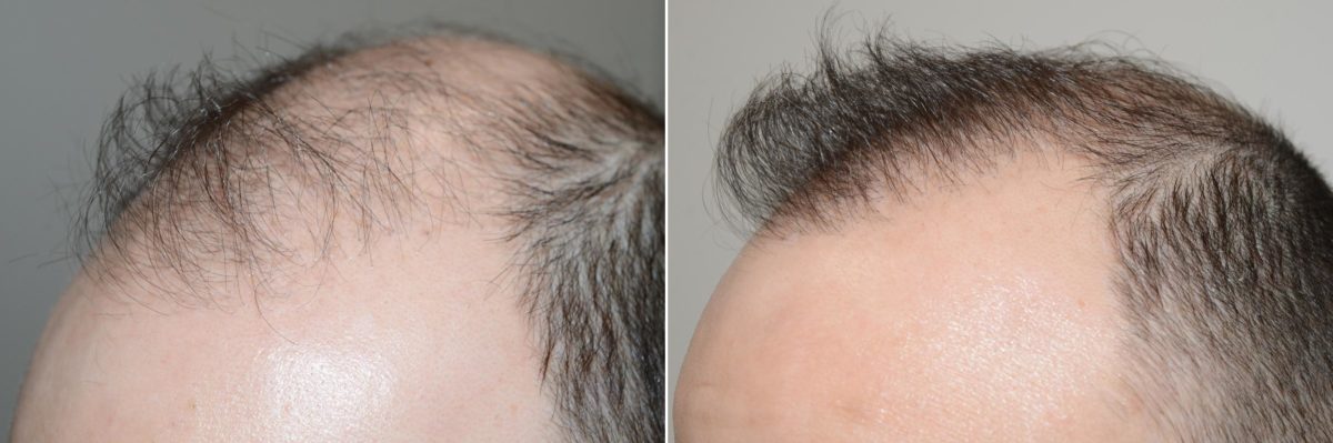 Body Hair Transplant Before and after in Miami, FL, Paciente 59126