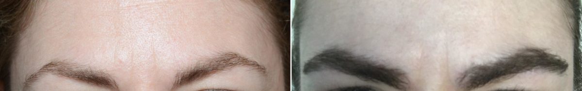Eyebrow Hair Transplant Before and after in Miami, FL, Paciente 59002