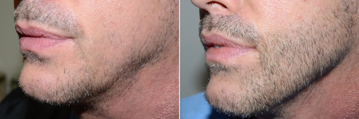 Facial Hair Before and after in Miami, FL, Paciente 59006