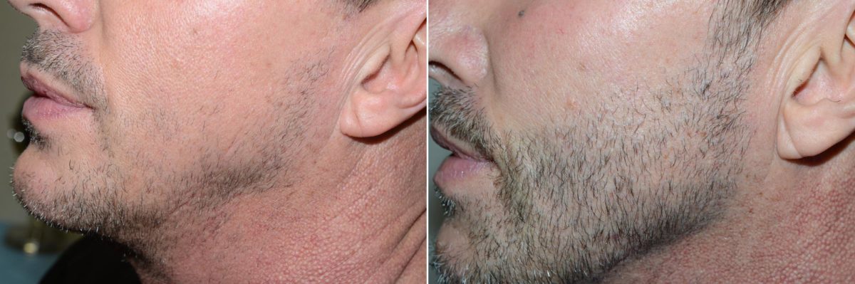 Facial Hair Transplant Before and after in Miami, FL, Paciente 59006