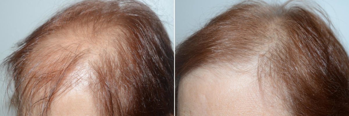 Hair Transplants for Women Before and after in Miami, FL, Paciente 59153