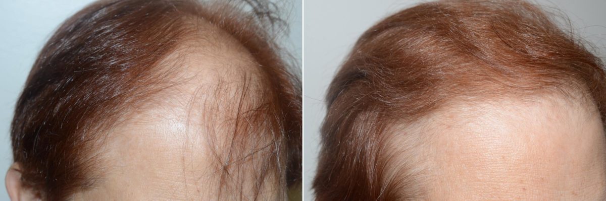 Hair Transplants for Women Before and after in Miami, FL, Paciente 59153