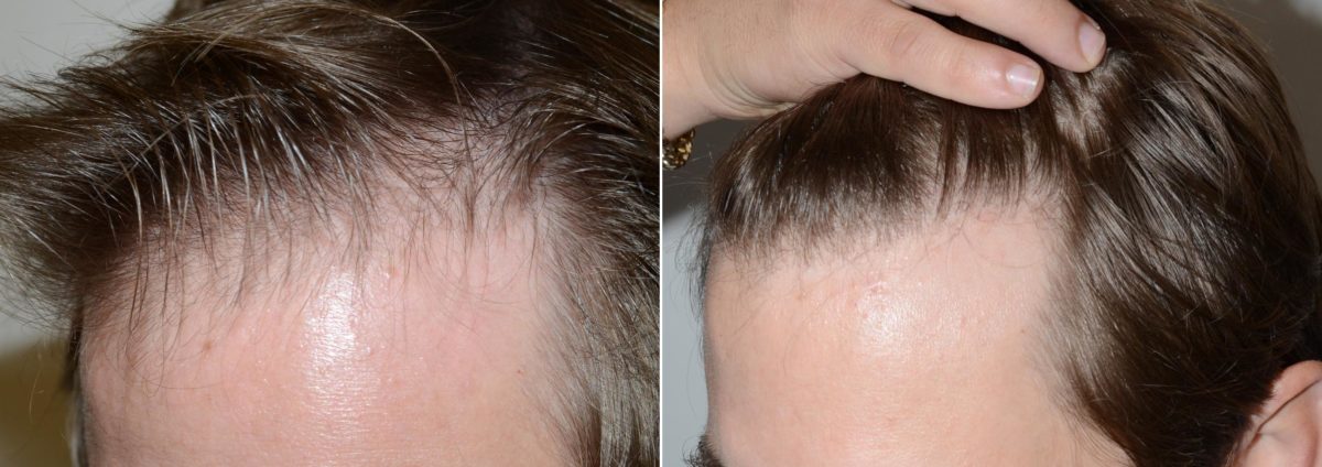 Hair Transplants for Men Before and after in Miami, FL, Paciente 59116