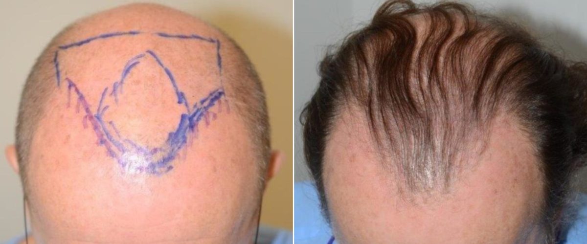 Hair Transplants for Men Before and after in Miami, FL, Paciente 59133