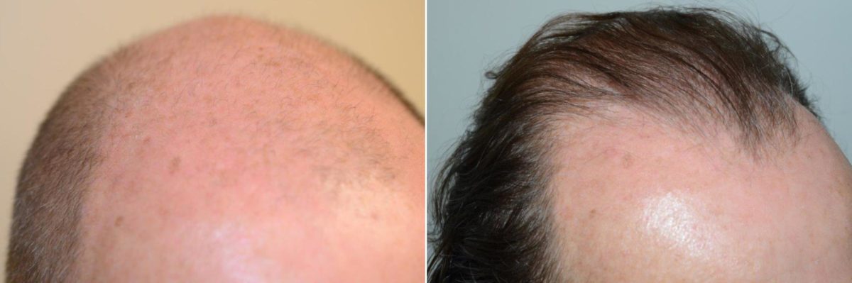 Hair Transplants for Men Before and after in Miami, FL, Paciente 59133