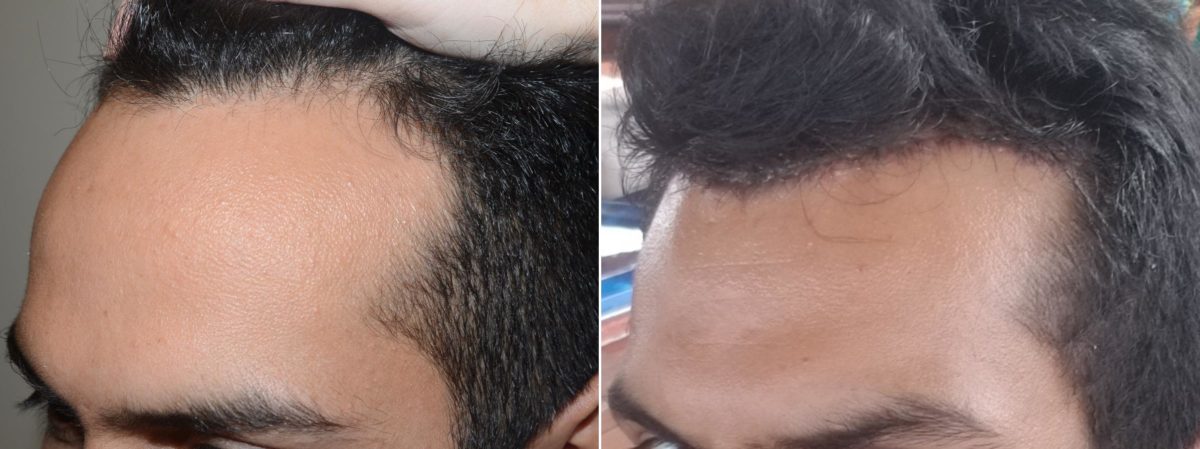 Hair Transplants for Men Before and after in Miami, FL, Paciente 59143