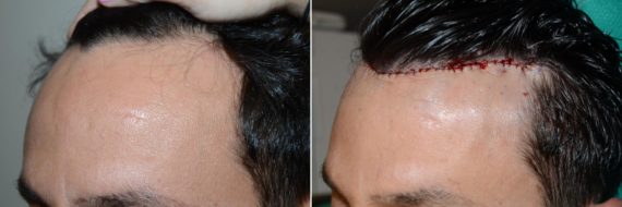 Hairline Advancement Before and after in Miami, FL, Paciente 59111